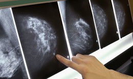 Nghiên cứu mới về xạ trị ở bệnh nhân ung thư vú trên 65 tuổi