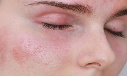 C&#225;ch xử tr&#237; n&#225;m da do d&#249;ng retinol chống l&#227;o h&#243;a