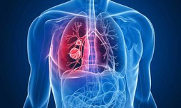 Ai cần tầm soát ung thư phổi?