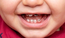 Những việc cha mẹ cần l&#224;m khi trẻ bị s&#226;u răng