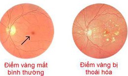 Thuốc mới trị thoái hóa điểm vàng do tuổi tác