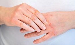 Biểu hiện của viêm da cơ địa ở từng lứa tuổi