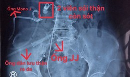 Phẫu thuật nội soi 1 lỗ (mini PCNL) ở tư thế nằm ngửa cho bệnh nhân bị sót sỏi, thận mủ và áp xe quanh thận