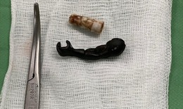 Bác sĩ gắp ra cánh tay siêu nhân, đầu bút... từ âm đạo bé 5 tuổi