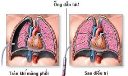 Đau ngực đột ngột, khó thở... cảnh giác với tràn khí màng phổi