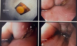 Xử trí đúng khi hóc dị vật đường tiêu hóa 