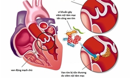 Ngăn ngừa biến chứng viêm nội tâm mạc nhiễm khuẩn