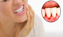 Viêm quanh răng mạn tính và cách chữa