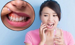 Viêm quanh răng: Nguyên nhân, biểu hiện và điều trị