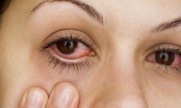 Những triệu chứng bất thường của đôi mắt ai cũng nên biết