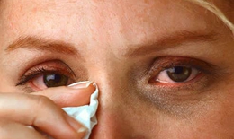 C&#225;c thuốc điều trị dị ứng mắt