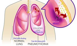 K&#233;n kh&#237; phổi: Nguy&#234;n nh&#226;n, nhận biết v&#224; điều trị