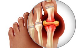 Biểu hiện của bệnh gout và cách chữa hiệu quả