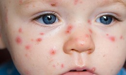 Bệnh thủy đậu ở trẻ: Nguyên nhân, triệu chứng và các biện pháp điều trị