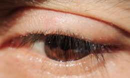 Các phương pháp trị viêm bờ mi mắt