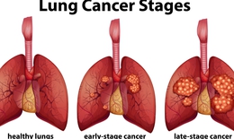C&#225;c giai đoạn sớm của ung thư phổi cần biết