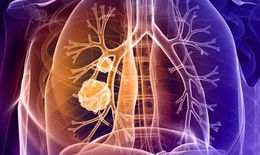 Những triệu chứng bất thường cảnh b&#225;o ung thư phổi