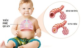Chữa viêm tiểu phế quản ở trẻ như thế nào?