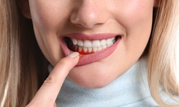 Mát xa đường viền nướu ngăn ngừa tụt lợi, loại bỏ cao răng