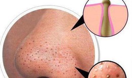 Các biện pháp giúp loại bỏ mụn đầu đen