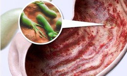 Thuốc chẹn H2 trị vi&#234;m lo&#233;t dạ d&#224;y do vi khuẩn H.pylori, cảnh gi&#225;c với t&#225;c dụng phụ