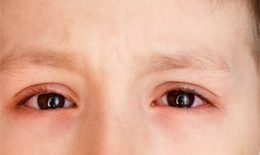 Ngứa mắt v&#224; đau mắt đỏ c&#243; thể l&#224; triệu chứng mới của COVID-19