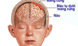 Bị ng&#227; sau 2 th&#225;ng mới ph&#225;t hiện bị tụ m&#225;u dưới m&#224;ng cứng, bệnh nh&#226;n phải phẫu thuật khẩn cấp