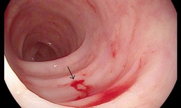 Vì sao cần dùng thuốc ức chế bơm proton trị loét dạ dày do vi khuẩn H.pylori?