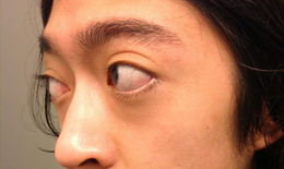 C&#225;ch điều trị lồi mắt trong bệnh basedow
