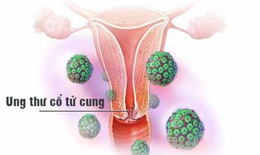 Lý do quan hệ tình dục sớm làm tăng nguy cơ ung thư cổ tử cung
