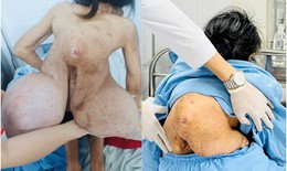 Hai lần phẫu thuật cắt bỏ khối u khổng lồ cho bệnh nhân 62 tuổi