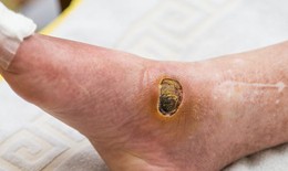 Bác sĩ cảnh báo biến chứng bàn chân ở bệnh nhân đái tháo đường