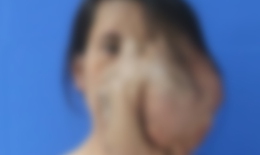 Người phụ nữ có khối u khổng lồ vùng mặt to như một chiếc đầu thứ hai