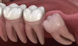 Răng mọc ngầm: Nguyên nhân, biểu hiện và điều trị