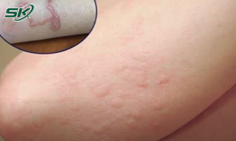 Ho dai dẳng do sán ký sinh khắp người