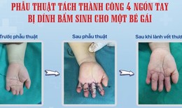 Bệnh viện Sản Nhi Nghệ An phẫu thuật tách thành công 4 ngón tay bị dính bẩm sinh cho trẻ