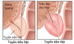 Món ăn bài thuốc hỗ trợ trị viêm tuyến tiền liệt