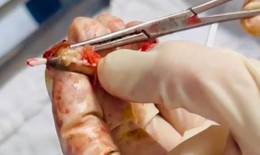 Người phụ nữ quên vòng tránh thai trong cơ thể 20 năm, kết quả tìm thấy vòng ở nơi không ngờ