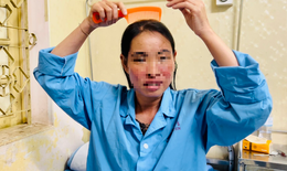 Mất tiền đi cấy tóc mới phát hiện bị lupus ban đỏ