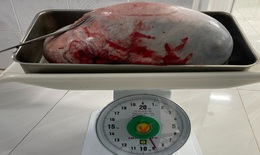 Bé gái 15 tuổi mang trong mình khối u nang buồng trứng "khủng" nặng 9kg