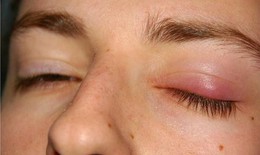 Lựa chọn các thuốc điều trị bệnh chắp mắt