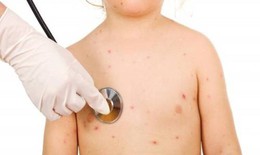 Biến chứng nguy hiểm của thuỷ đậu