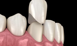 Những lưu ý khi bọc răng sứ?