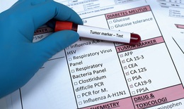Bạn biết gì về các chỉ số xét nghiệm máu trong sàng lọc chẩn đoán, theo dõi ung thư phổi?