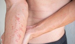 Viêm da dị ứng là gì?