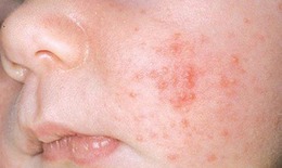 Mụn trứng cá ở trẻ sơ sinh, nhũ nhi: Nguyên nhân và phương pháp điều trị