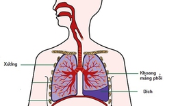 Tr&#224;n dịch m&#224;ng phổi: Nguy&#234;n nh&#226;n, biểu hiện v&#224; điều trị