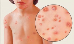 Bị thủy đậu sẽ gặp những biến chứng nào?