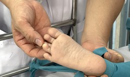 Bệnh tay chân miệng: Cha mẹ bình tĩnh, không phải cứ đưa trẻ lên tuyến trên là tốt nhất