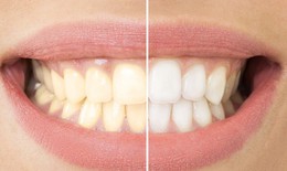 Tự ý tẩy trắng răng bằng sản phẩm mua trên mạng xã hội, lợi bất cập hại
